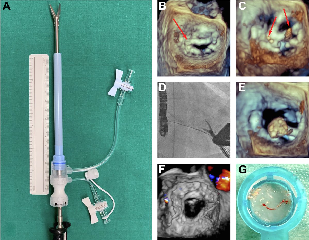 JACCJournals's tweet photo. First report of transapical scissor mediated mitral commissurotomy pre-TMVR with Tendyne valve! https://t.co/fx3WcrBzzb

#JACCINT #TMVR #CardioTwitter https://t.co/iDmEZaEh1v