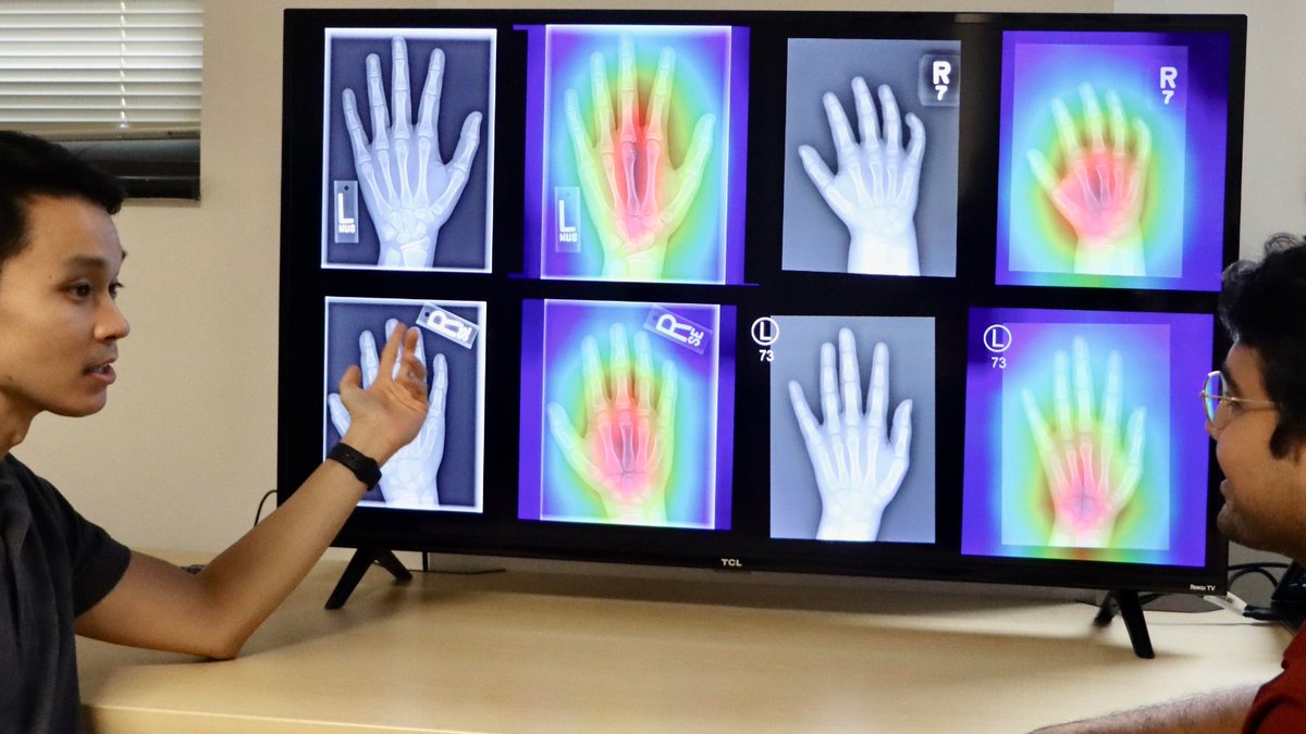 Univ. of Maryland School of Medicine &amp; Fischell Institute researchers recently showed how a state-of-the-art AI model used to measure bone age in pediatric populations exhibited sex-, age-, and race-based biases when applied to diverse populations. fischellinstitute.umd.edu/news/story/ai-…