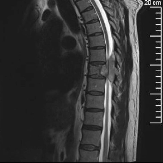 Plasmacytoma causing T7-T9 spinal cord compression