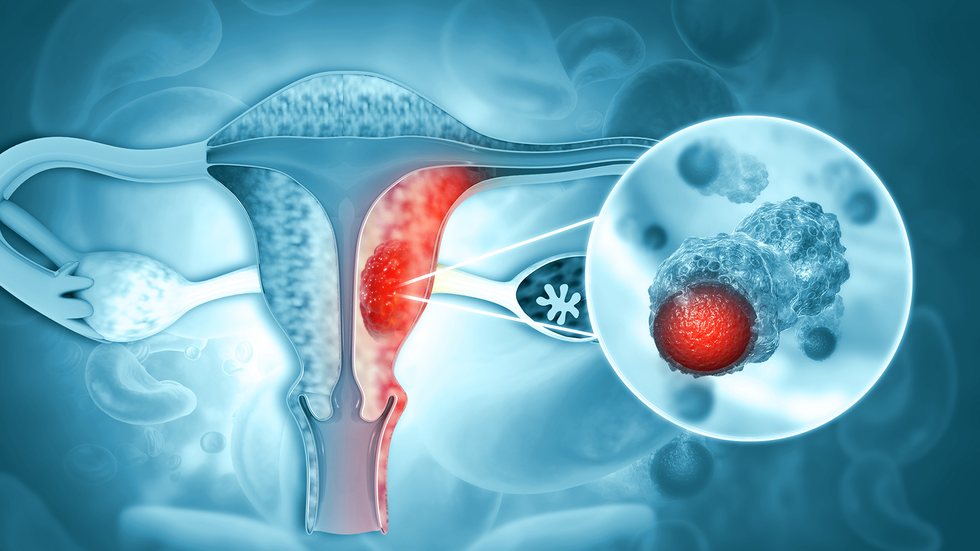 Testimonios de mujeres con cáncer de endometrio