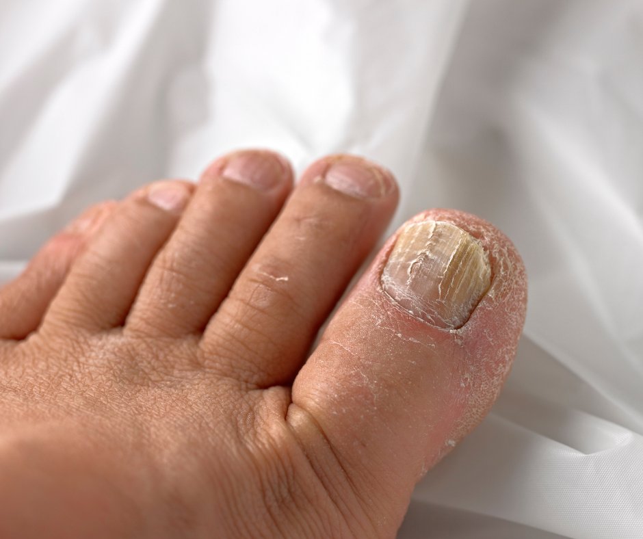 Suffering from stubborn #toenailfungus? The #FootandAnkleAssociatesofCleveland team has curated a list of solutions just for you! Read this week's blog to learn more about toenail #fungus and our recommended solutions! bit.ly/3D6gX4m

#FungalInfections #ToenailHealth