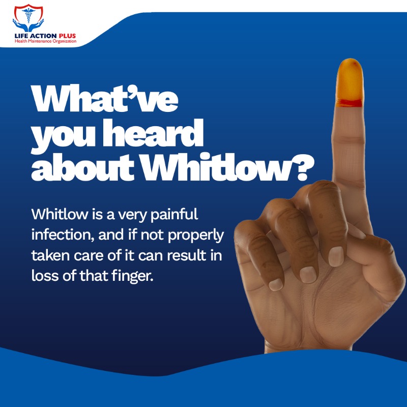 lap_hmo's tweet photo. Most people that has experienced this disease often describe it as pain. Intense pain.
Avoid it by maintaining good hand hygiene at all times.
#LapHMO #Whitlow #infection #handinfections #bacteria #bacterialdisease #fungi #treatment #educatepeople #educateyourself