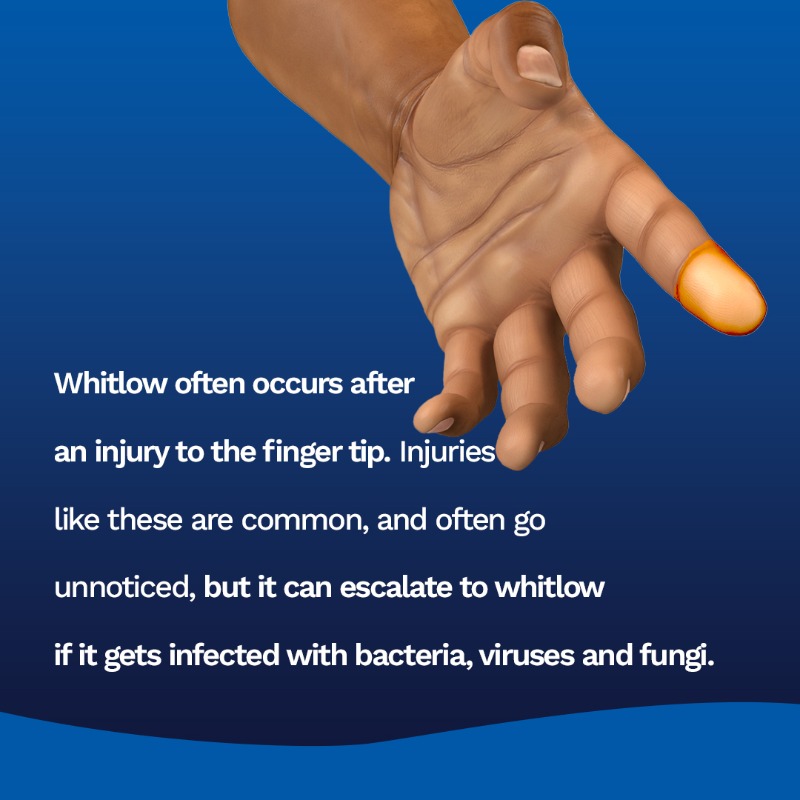 lap_hmo's tweet photo. Most people that has experienced this disease often describe it as pain. Intense pain.
Avoid it by maintaining good hand hygiene at all times.
#LapHMO #Whitlow #infection #handinfections #bacteria #bacterialdisease #fungi #treatment #educatepeople #educateyourself