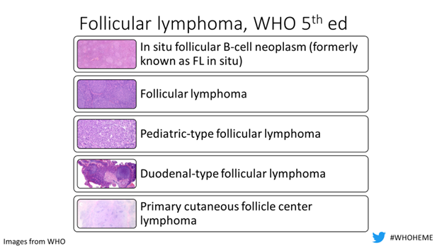sanamloghavi's tweet image. Back with another episode of #WHOHEME this time covering what’s new (or old but gold) in Follicular Lymphoma #hemepath #LymSM … diagnostic pearls 🔬 
@WHO 5th ed recognizes 5 flavors of FL… tune in &amp;amp; remember ISFBN, pediatric, duodenal and primary cutaneous are very indolent 1/