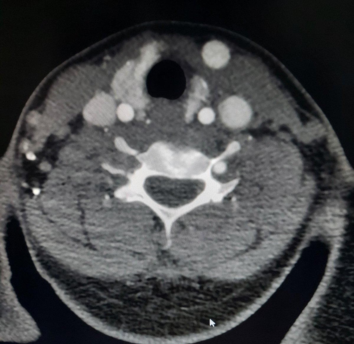1/2
Hey #neurorad #radres A wise radiologist said, It's always difficult to find when something is missing!
30yr male with trauma
MR C.spine done,based on which CT angio done later
✅️Always look for the flow voids in any MR sequence/scan
✅️Always compare with opposite side🧐