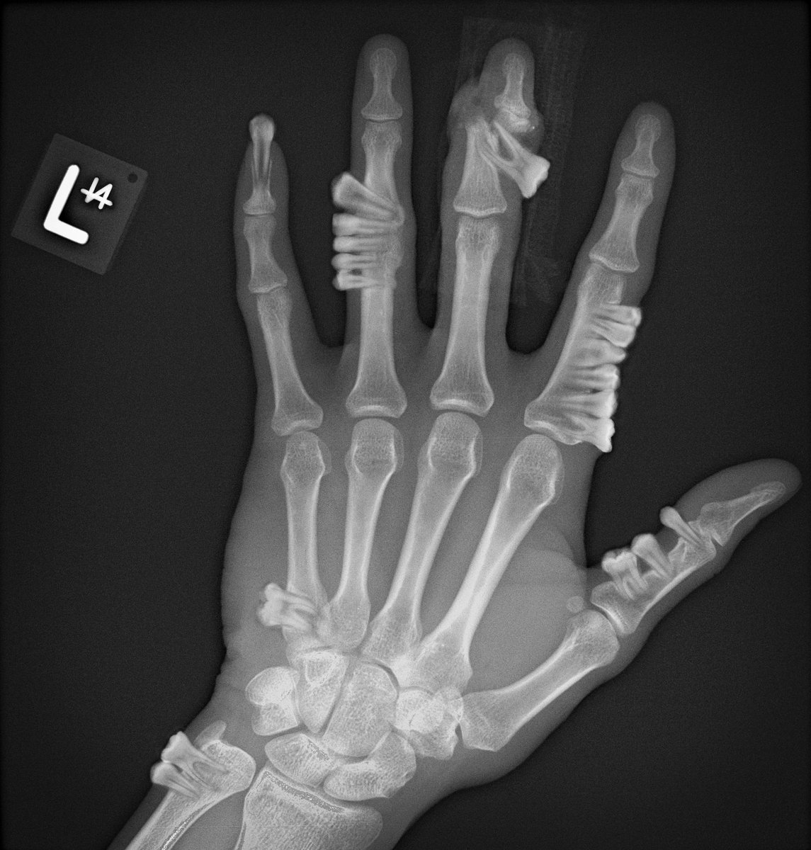 Calcium hyperproficiency is a rare complication of vitamin D deficiency, where excess calcium from bone resorption forms complex structures resembling primary teeth.
Neoformed teeth grow on different bones, such as this patient's hand, causing fractures and joint dysfunction.