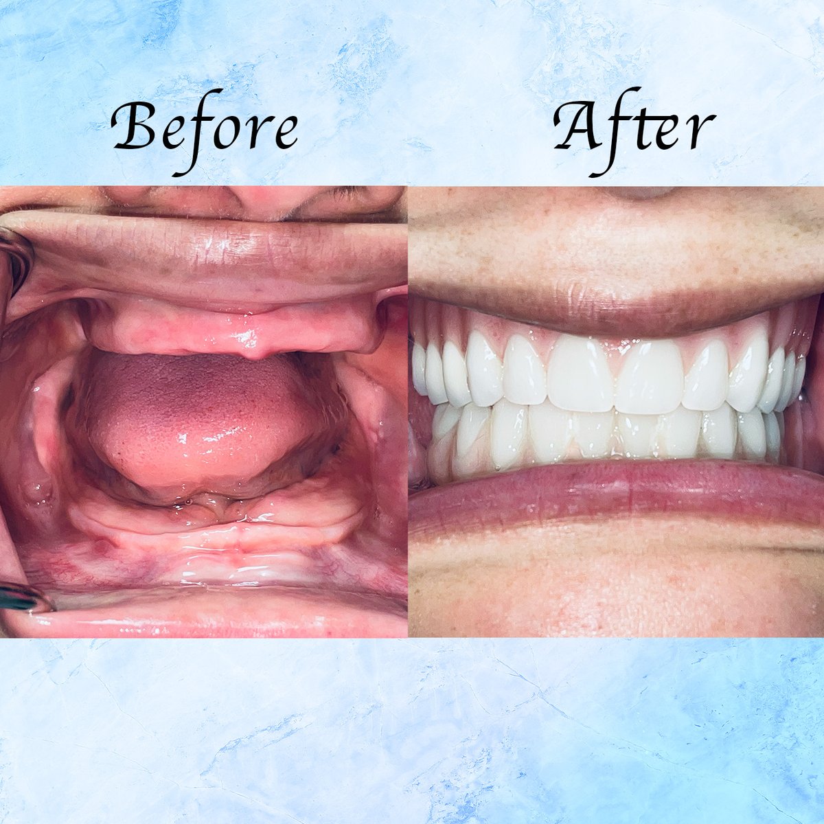 cdic_dmd's tweet photo. Brenda came to our office with edentulous jaws and wearing rather worn out pair of complete dentures. She expressed the desire to replace her lower denture with an All-On-Four fixed prosthesis and redo the upper denture. 

Behold the dramatic changes! https://t.co/rjxGST3E9Q