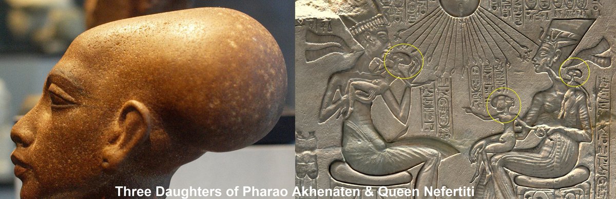 MC_Floh's tweet photo. Elongated Skulls common among Ancient Egyptian Rulers? 🤔

• King #Tutankhamun
• Pharao #Akhenaten
• Queen #Nefertiti (Akhenaten's wife)
• Daughters of Akhenaten &amp; Nefertiti

#King #Tut #Pharao #Echnaton #Egypt
#elongated #skulls #heads #cranial #deformation #Inka #Paracas https://t.co/S6EbOxQwbG