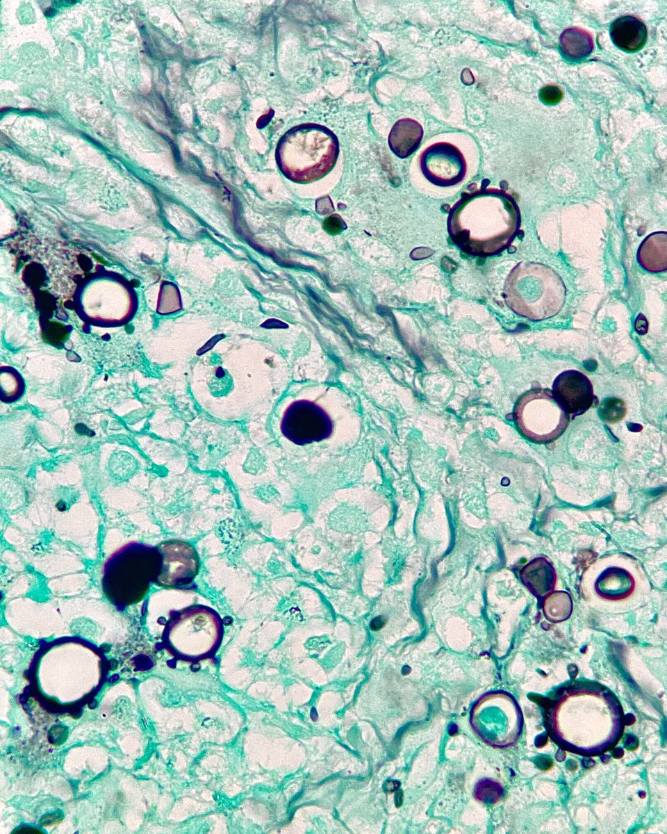 ClevesMario's tweet image. Diagnosis?

#medicine #anatomy #medschool #pathology #histology #medlife #histologia #path #pathologists #fungi #fungus