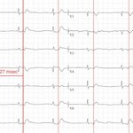 Photo by ECG Cases (@ecg_cases)
