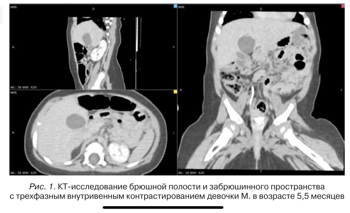 sminaev2015's tweet photo. Дивертикул общего печеночного протока у грудного ребенка #some4surgery #some4pedsurg #sminaev #children #laparoscopy #bileducts #diverticulum #portoenteroanastomosis #cholecystectomy https://t.co/Ln3hqNJNLX https://t.co/F02B7uKKwu