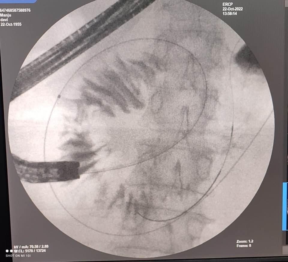 gecdm's tweet photo. EUS GUIDED GASTROJEJUNOSTOMY…The free hand technique..water instillation via NBD drain is the most apt as it can be done through the scope…saves time and easy to negotiate… https://t.co/gqpsFvG7pW