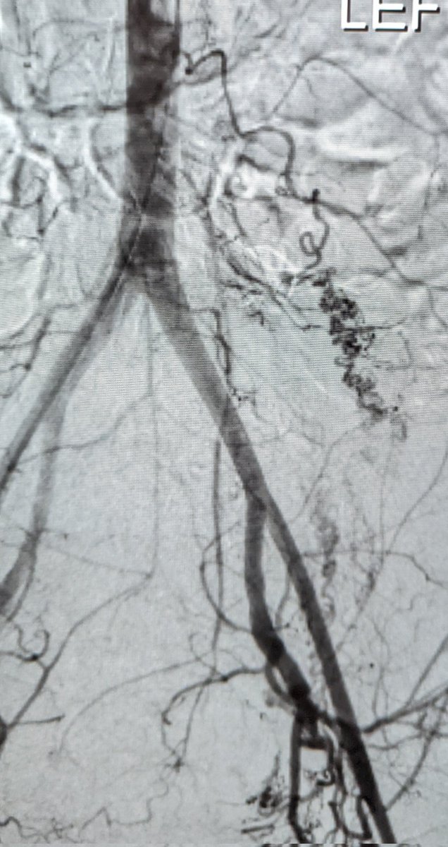 Young pt w post partum hemorrhage

Large uterine arteries as expected &amp; well embolized. 

But who would treat this left ovarian artery supply? <a href="/SIRRFS/">SIR RFS</a> 

...I know what I did 

#IRad <a href="/SIRspecialists/">Society of Interventional Radiology</a> <a href="/SIR_ECS/">SIR ECS</a> <a href="/thefibroidlady/">Theresa M. Caridi MD, FSIR</a>