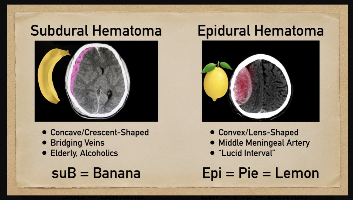 Epidural Hematoma Vs Subdural Hematoma