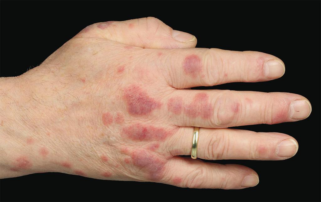 A 65-year-old man 

👉 5-day history of a painful rash on his hands and elbows. He had no other symptoms