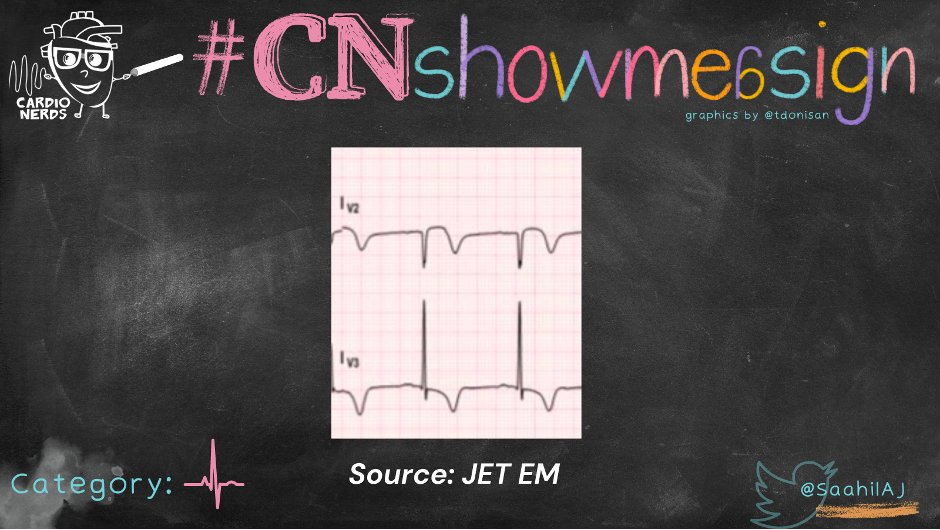 Well Well Well Look What We Have Here What Does This Sign On EKG well-well-well-look-what-we-have-here-what-does-this-sign-on-ekg