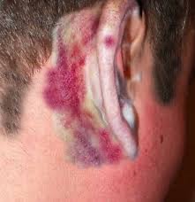 A patient presented following a motor vehicle accident. What is clinical sign & likely diagnosis? (Image: Health jade) #Medtwitter