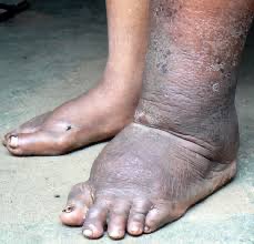 BrownJHM's tweet photo. A patient presents to a clinic in India for routine physical exam. What is the finding/diagnosis? #Medtwitter https://t.co/4RwqkUUoiq