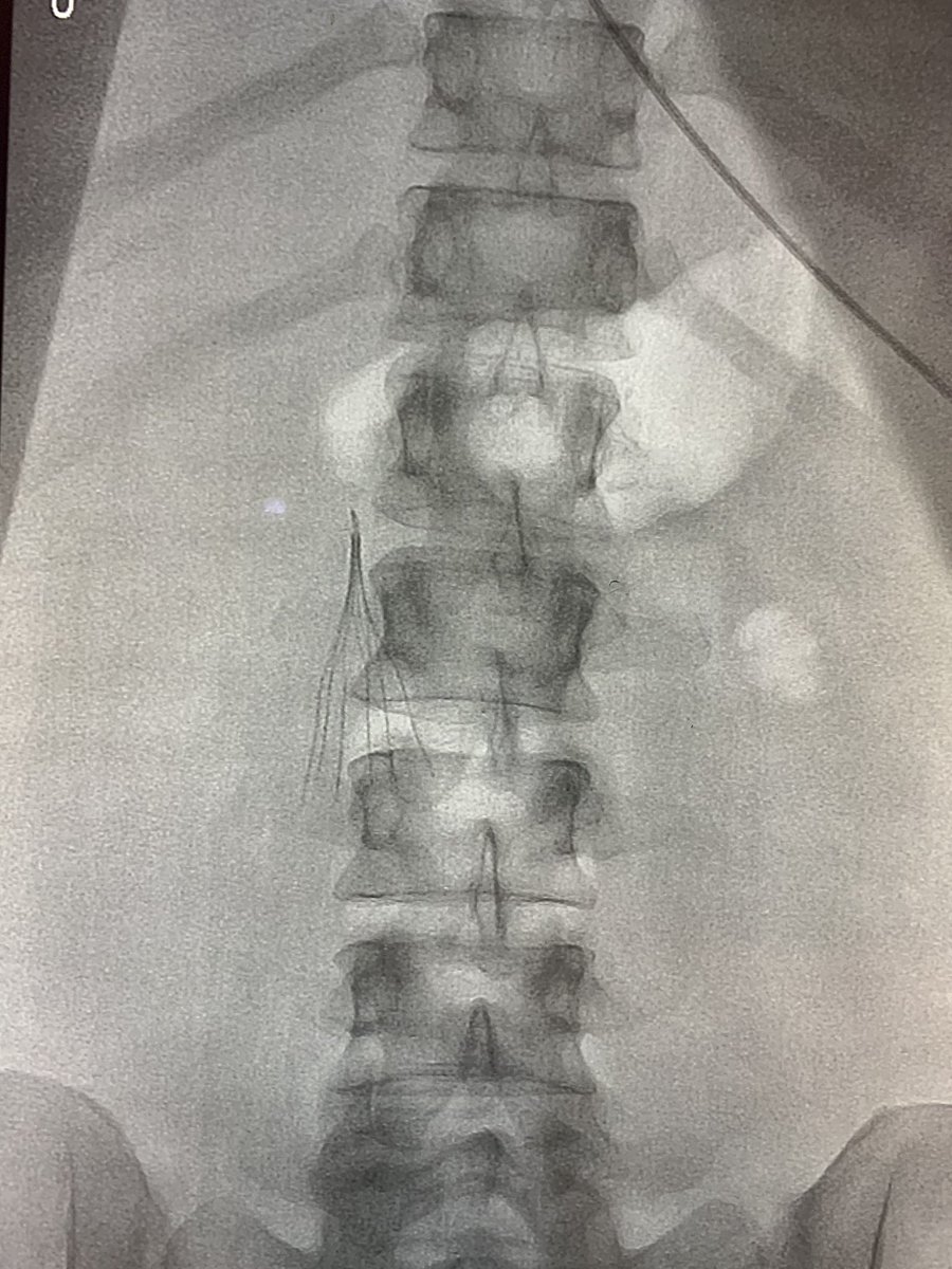 JoeW003's tweet photo. Clot catcher, deployed 🕸
@ArgonMedical #OptionELITE #DVT #TogetherOurMissionIsClear https://t.co/TBnXiV8ZVF