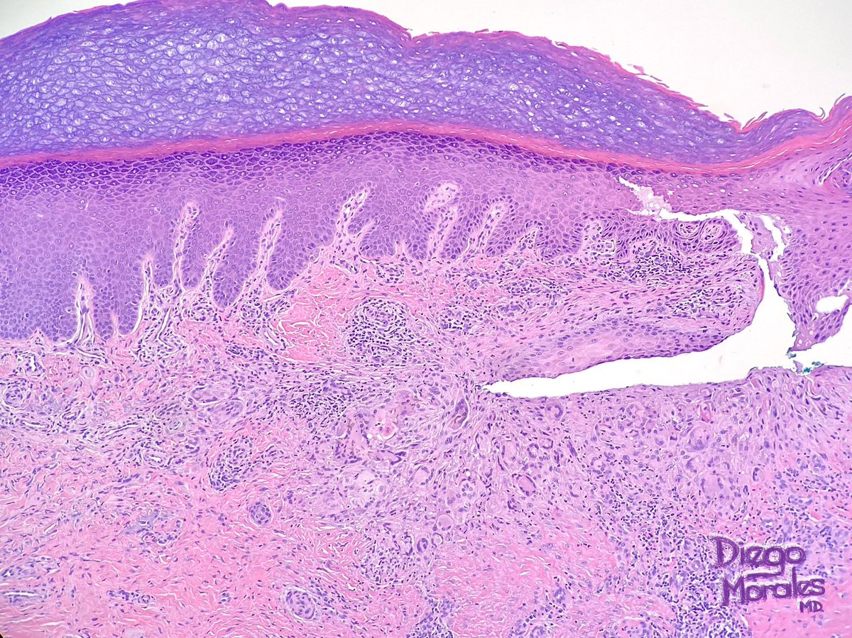 My mnemonic 2 remember phaeohyphomycosis:

 *Phaeo (I think of pheomelanin bc it is pigmented [dematiaceous])

*hypho (bc hyphae predominate & lacks Medlar bodies, as opposed to Chromomycosis) and 

*mycosis (bc 🍄)

All the rest is in this brilliant 🧵👇🏼

#PathTwitter #dermpath