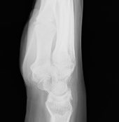 anilbhatortho's tweet photo. #orthotwitter #MedTwitter
#Kienbock’s disease .. Radial shortening still works well in gross negative ulnar variance .. 4 years post op
@OrthoM8 @TweetsOrtho @orthobullets @JHSEur @bone_mechanic @OrthoJC https://t.co/PdCELpoVRw