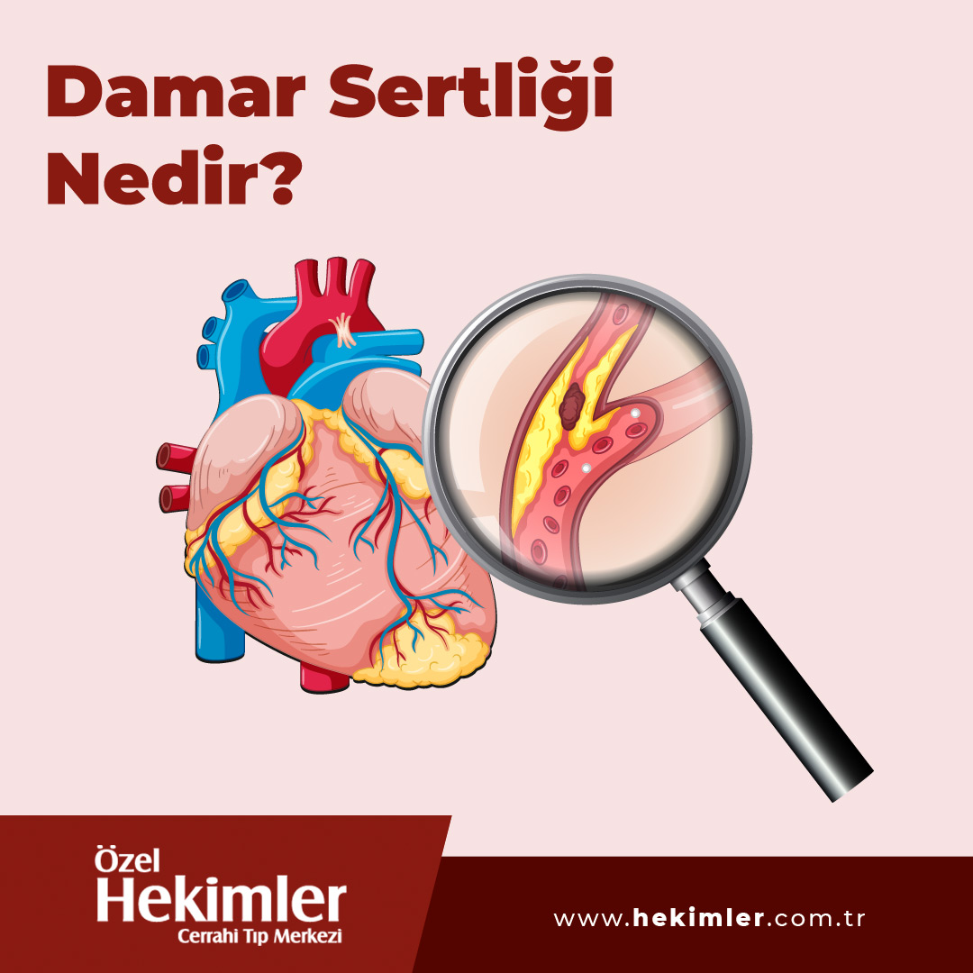 HekimlerTIP's tweet photo. Damar Sertliği (Ateroskleroz) Nedir?
Kalp hastalıkları birçok şekilde kendini gösterebilir. Damar sertliği, en yaygın kalp rahatsızlıklarından biridir. Yüksek kolesterol, yüksek tansiyon, diyabet ve genetik etkiler gibi birçok nedenden kaynaklanabilir. https://t.co/q4kACopjfm