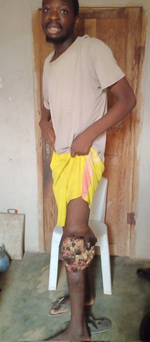 ZIPPYnla's tweet photo. The first picture was before the operation and the second picture was after the amputation.  After the amputation I was refer to UCH ibadan for chemotherapy and radiotherapy. But unfortunately for me the chemo is not working but instead it was damaging my cells, now I was told I https://t.co/pj8c5HIQjr