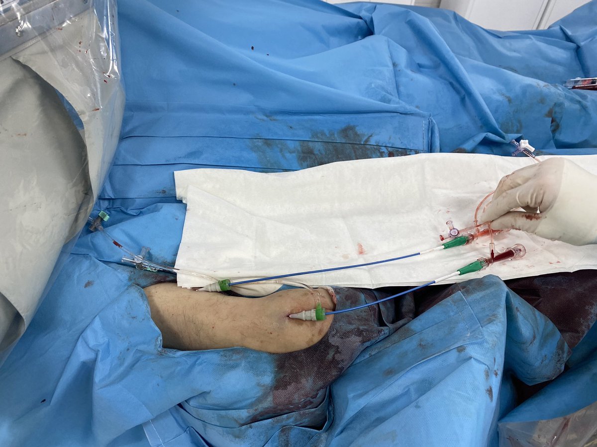 <a href="/ProkhorPavlovMD/">Dr. Prokhor Pavlov, MD</a> Prokhor, while in Russia, 3 weeks ago I travelled to Yoshkar-Ola town to learn DRON technique from its inventor - Dr Alexey Shubin, the Master of endovascular interventions. We did 3 CTOs on that day with DRON.