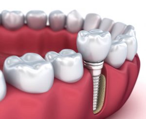 İmplant Diş Fiyatları
İmplant fiyatları dişsizlik problemi ve diş eti hastalığı olan hastaların en çok aradıkları.. 
#implant #implantdiş #implantdişfiyatları #implantfiyatları2022 #dişhekimi #implantdişhekimi #ömerkutay
omerkutay.com/implant-fiyatl…