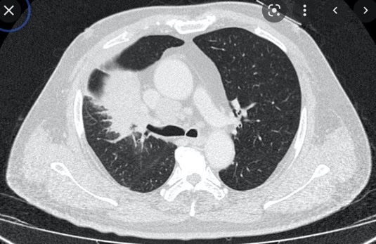 BrownJHM's tweet photo. A middle aged patient presented with difficulty walking up the stairs, shortness of breath &amp; a new rash on her hands &amp; back. What is the likely diagnosis? #Medtwitter https://t.co/EJOeybTuWr
