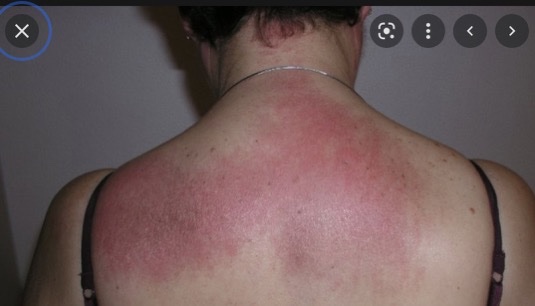 BrownJHM's tweet photo. A middle aged patient presented with difficulty walking up the stairs, shortness of breath &amp; a new rash on her hands &amp; back. What is the likely diagnosis? #Medtwitter https://t.co/EJOeybTuWr