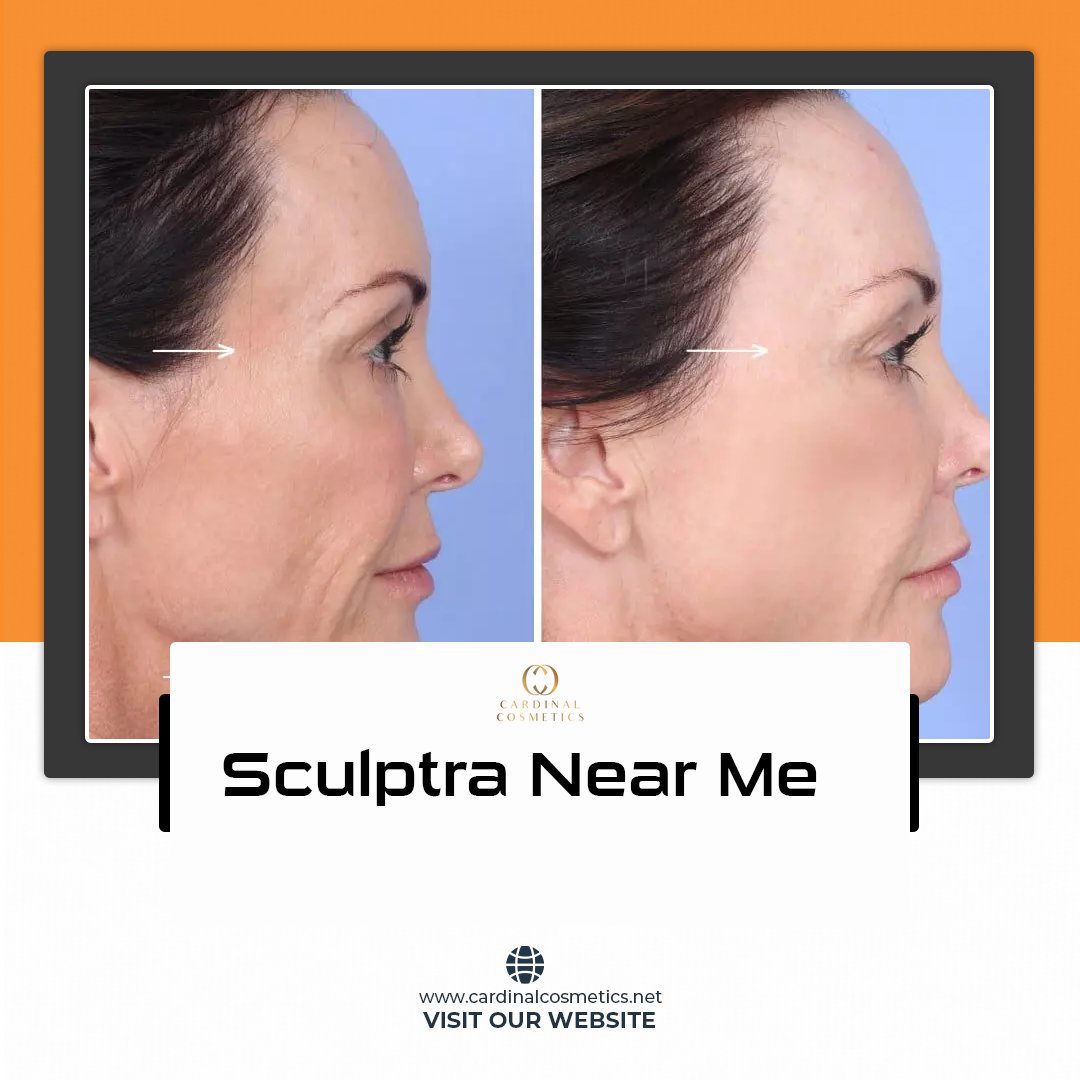 Sculptra therapy not only restores your skin health but stimulates your skin to regain its natural elasticity. Our beauty center will make you flawless.
cardinalcosmetics.net
#sculptra #sculptrafacial  #beauty #botoxfacial #botoxday #aginggracefully #dermafillers #medspa