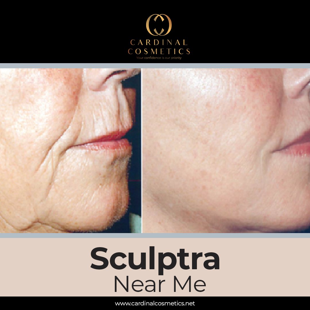 Turn back the clock with Sculptra, an injectable product that stimulates your bodies natural collagen production for a more youthful appearance.
cardinalcosmetics.net
#sculptra #sculptrafacial  #beauty #dermafillers #dermafillertreatment