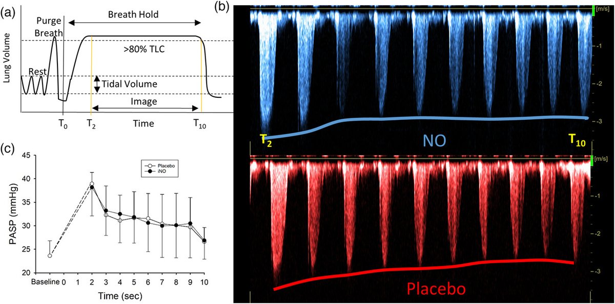 Happy to share a recent paper by PhD student Andrew Brotto from our lab showing that a single breath of NO does not alter pulmonary vascular pressures. Good support for the use of DLNO! tinyurl.com/h26crw48