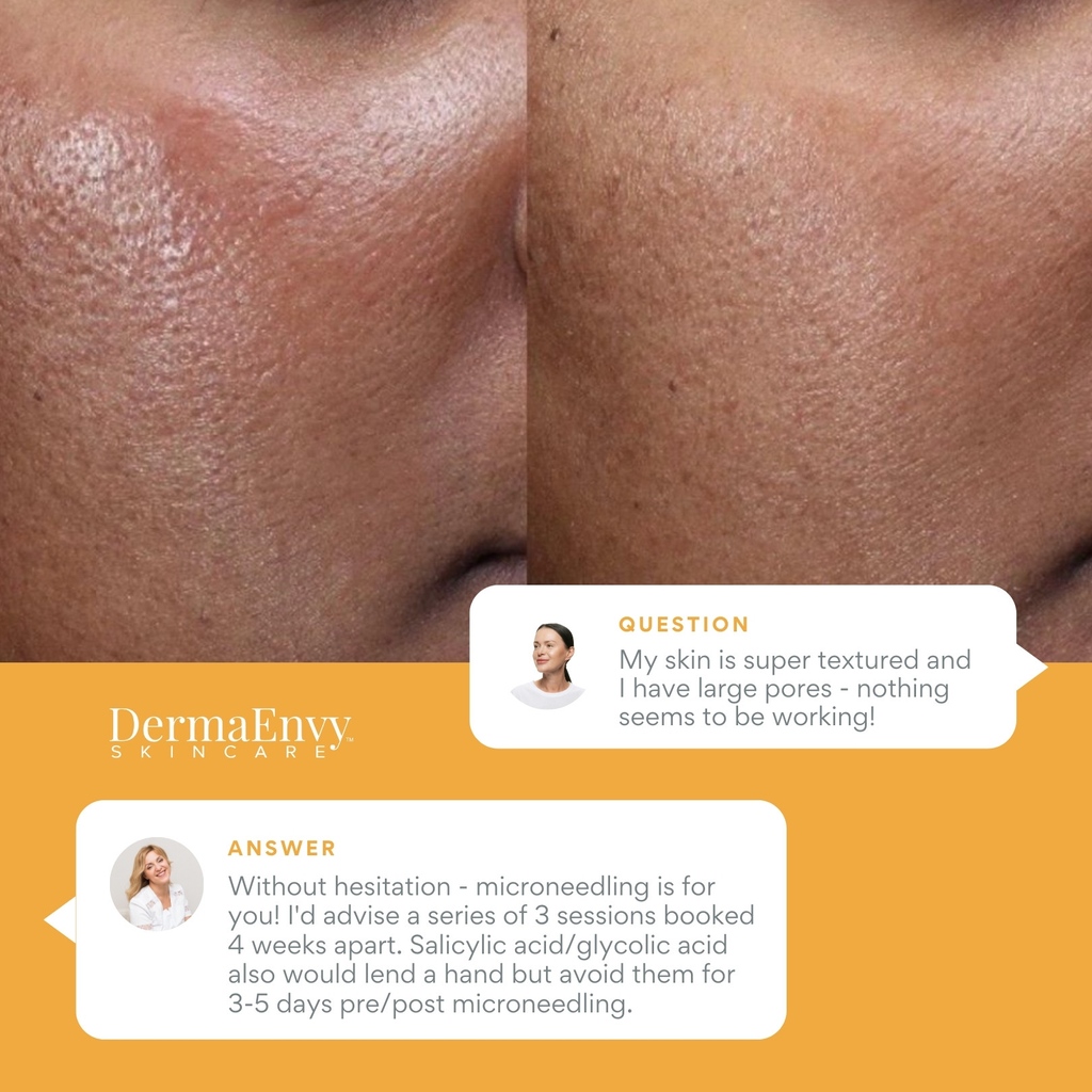 Large pores are a popular skin concern brought up during a skin consultation and one of our go-to treatments here at DermaEnvy is microneedling! 👏 

➡️ Book a free skin consultation and discuss the best plan of action for your specific skin goals.