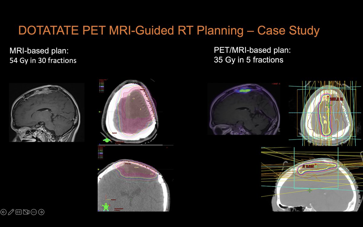 jana_ivanidze's tweet photo. Thanks so much @ThomasNgImaging & colleagues @MGHImaging #JPNM for inviting me to talk about #meningioma #PETMR - great discussion of current clinical evidence & (near) future applications
@WCMRadiology @MolecularWCM https://t.co/dAjdPnGa2o