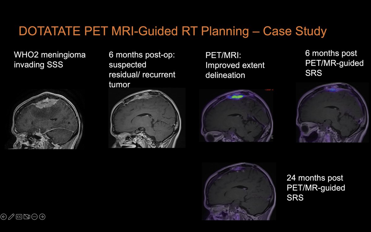 jana_ivanidze's tweet photo. Thanks so much @ThomasNgImaging & colleagues @MGHImaging #JPNM for inviting me to talk about #meningioma #PETMR - great discussion of current clinical evidence & (near) future applications
@WCMRadiology @MolecularWCM https://t.co/dAjdPnGa2o