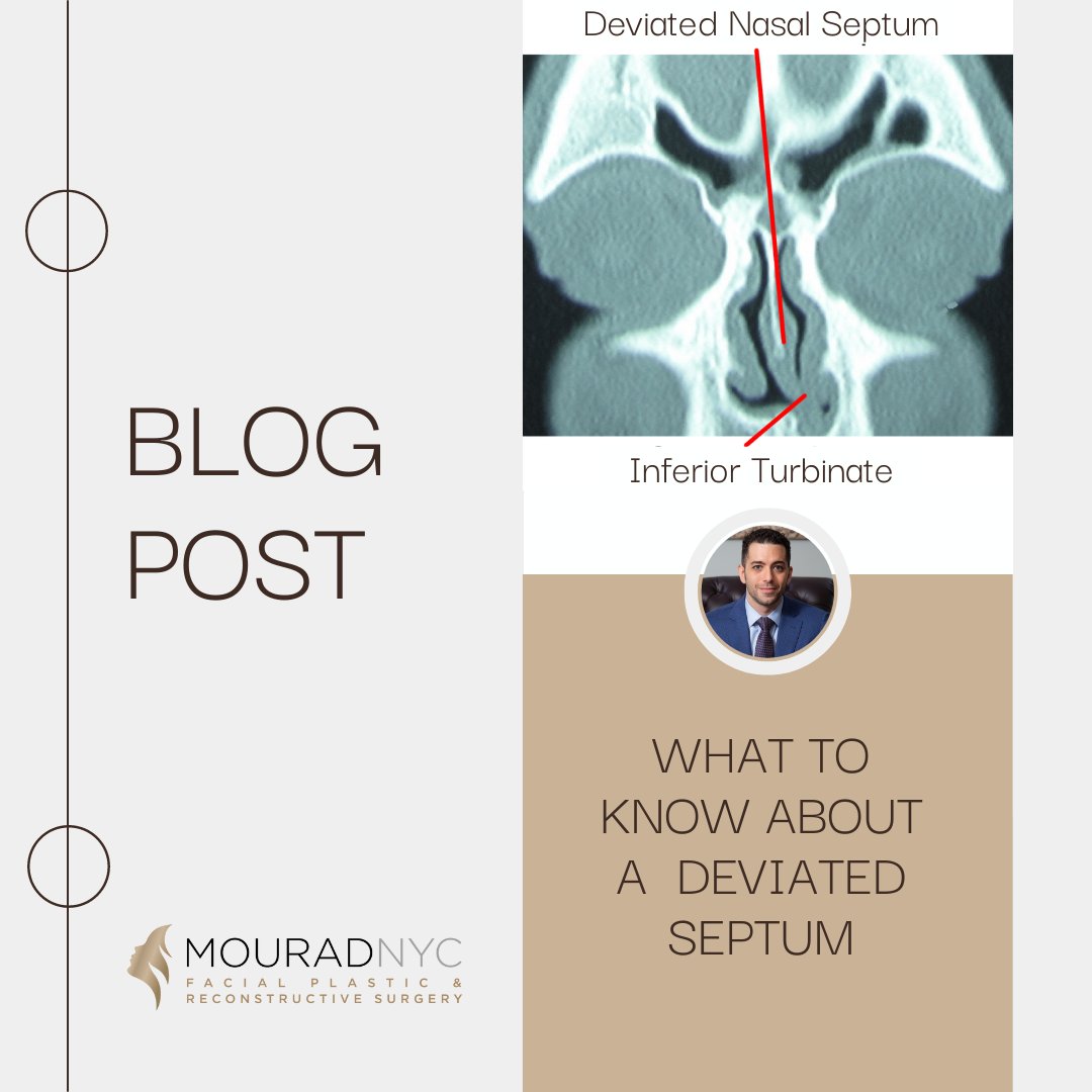 NYCFaceDoc's tweet photo. Did you know a deviated septum affects around 80% of the population to some degree and is usually genetic? Click here to learn more 👃 https://t.co/EcZt1QwaLj https://t.co/62IkyqnJSk