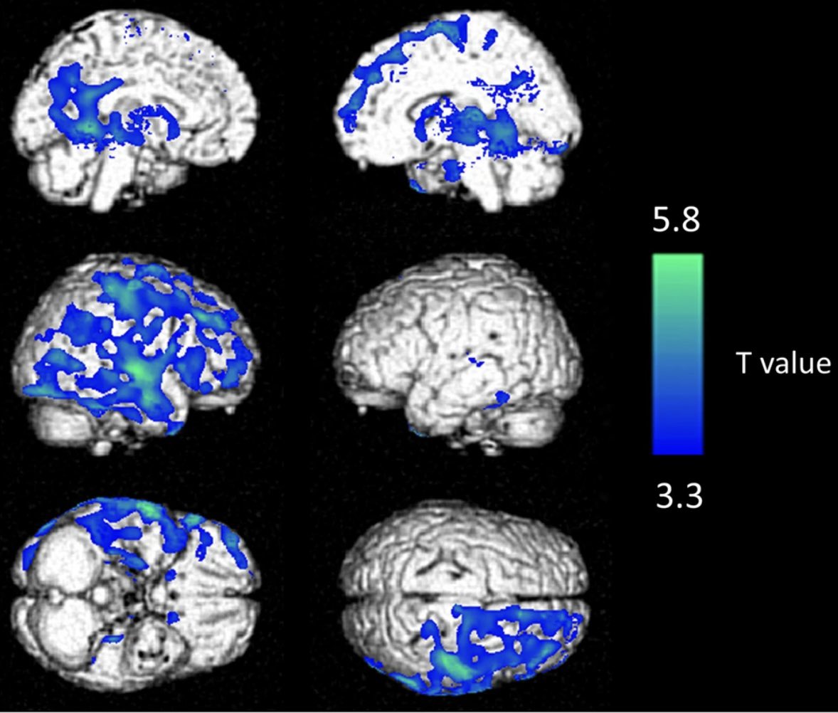 1/🧠 LONG COVID BRAIN 🧠 
28 #LongCovid patients with neurological symptoms 
PET brain scan
Result: ALL showed hypometabolism in multiple brain areas. 
This is what it looks like 
(blue areas are areas of hypometabolism)