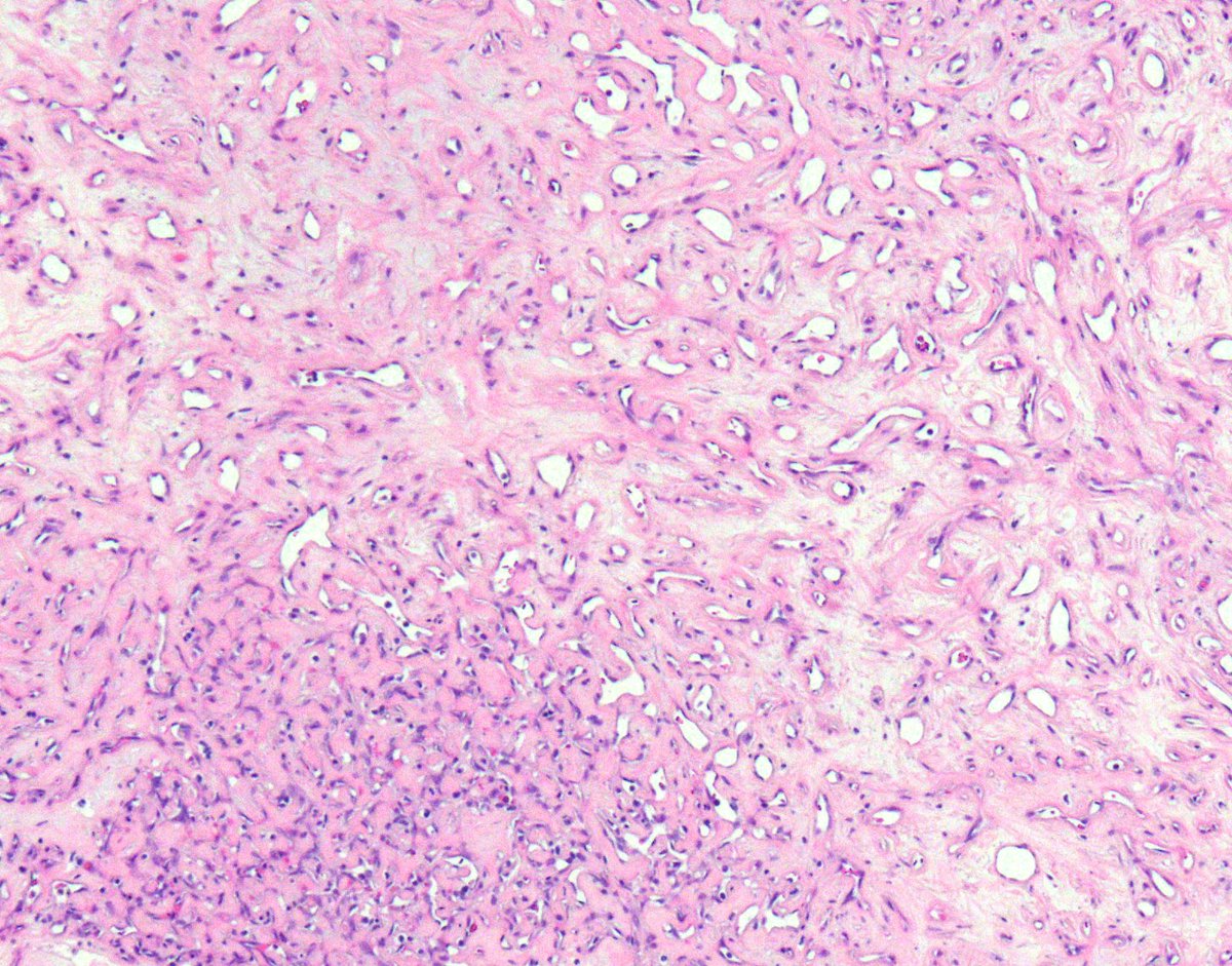 Morphologic manifestations of Regression in 
Clear Cell Renal Cell Carcinoma 

- Cell drop out
- Edema
- Fibrosis/sclerosis
- Vascular prominence

#kidneycancer #KidneyWk #gupath