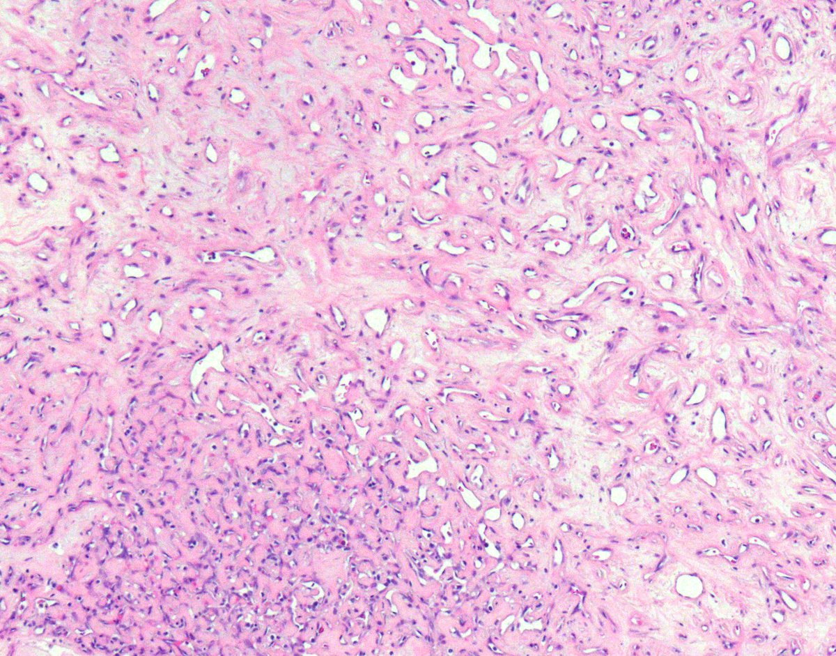 Morphologic manifestations of Regression in Clear Cell Renal Cell Carcinoma - Cell drop out - Edema - Fibrosis/sclerosis - Vascular prominence #kidneycancer #KidneyWk #gupath