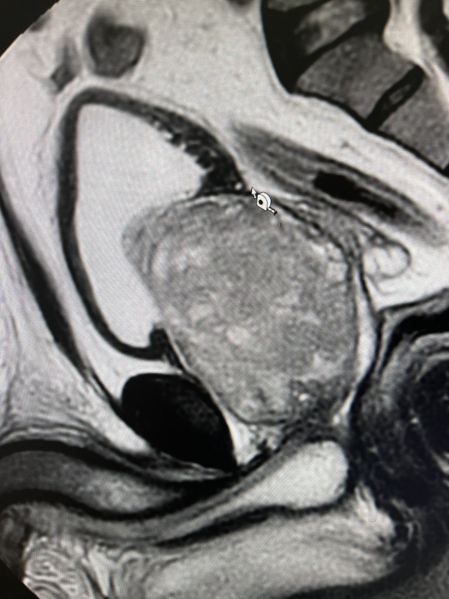 PavlakisPavlos's tweet photo. Today a difficult dissection due to high volume 188cc for Gleason 4+4 . https://t.co/XNhfE8m43O