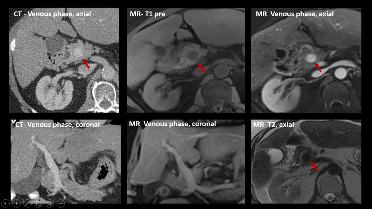 Take a look to coronal plane and MR! 😉 ✔ Round hyperdense structure in axial ✔ It enhances after IV contrast. Hypervasvular tumor you may think.. however hypointense on T2 (exclude NET) ✔In coronal it is a tubular structure, it is actually the portal vein!