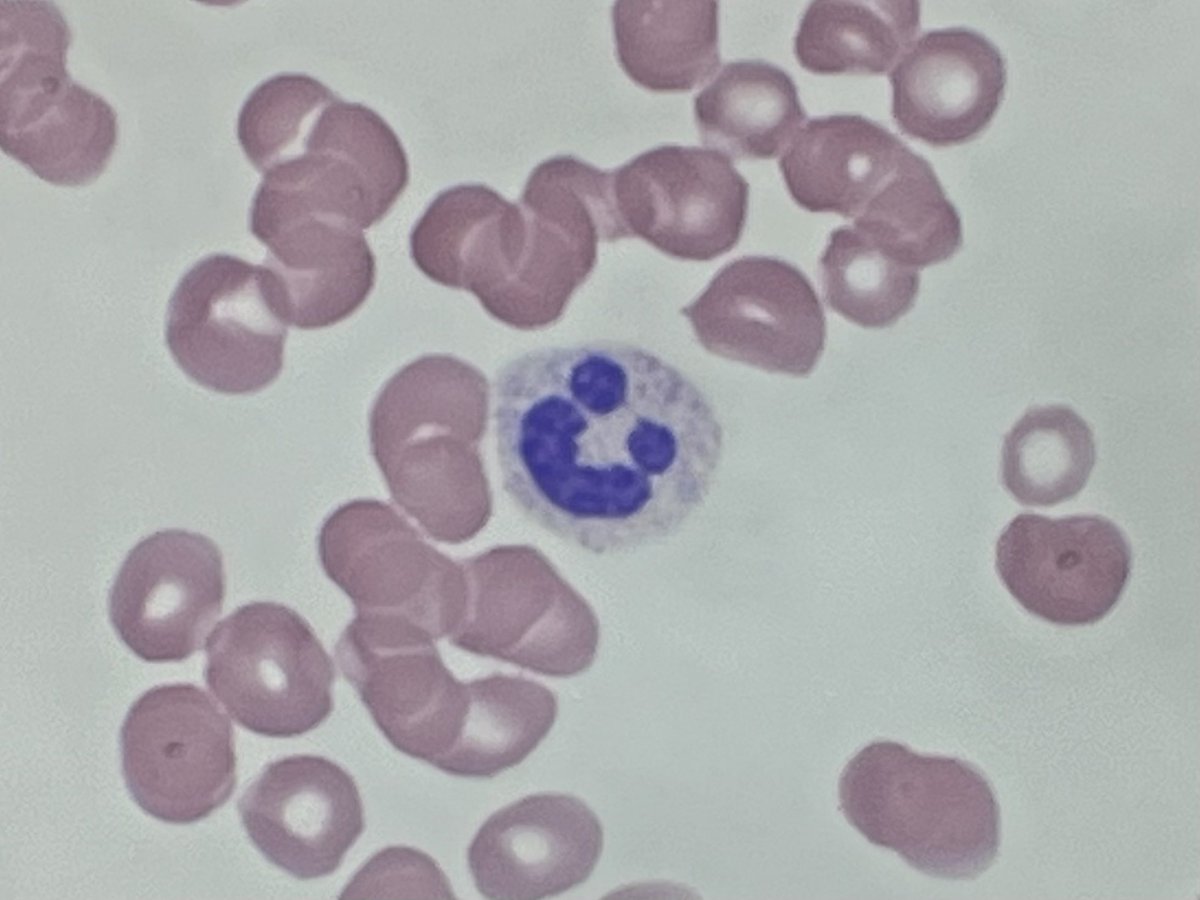 MoAli_Path's tweet photo. The many faces of a neutrophil #funpath #dysplasia #hemepath https://t.co/jUQgtY7Khy