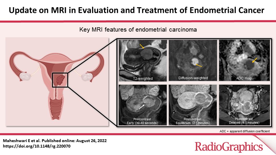 Update on MRI in Evaluation and Treatment of Endometrial Cancer ​ Maheshwari E et al Obstetric & Gynecology Imaging doi.org/10.1148/rg.220… @dr_ektam @ericasteinMD @AnnKloppMD @PamSolimanMD @KateMaturen @andrea_rockall @RadITrainEditor @LizSadowski @AVenkatesanMD #RGphx 14/19