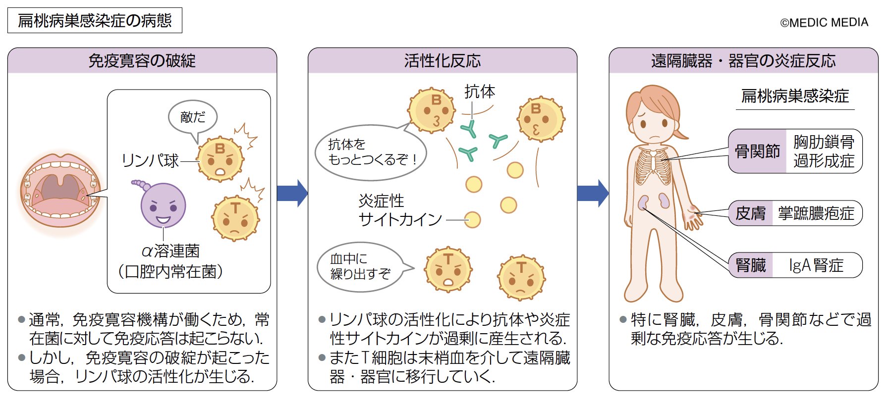 病気がみえる 扁桃病巣感染症 急性扁桃炎が慢性化した場合 扁桃を病巣として 扁桃から離れた臓器 組織に病変を生じる扁桃病巣感染症を引き起こすおそれがある 扁桃病巣感染症の三大疾患として Iga腎症 掌蹠膿疱症 胸肋鎖骨過形成症があり 女性に