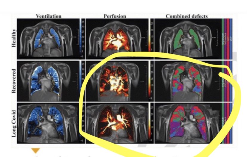 lisa_iannattone's tweet photo. I know everyone that bothers to read the primary literature is very aware that SARS2 damages the immune system but I would like to remind everyone that it also damages kids’ lungs. Even apparently recovered and asymptomatic kids. The pediatric hospital crisis isn’t a mystery. https://t.co/tvpfI1yb1E
