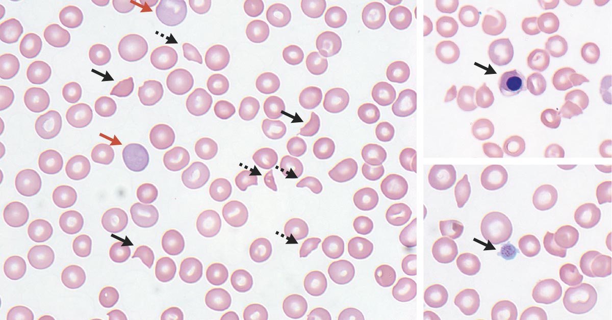 A 59-year-old man presented with a 3-week history of fatigue, lightheadedness, and bifrontal headache. Two weeks earlier he had had watery diarrhea, including one episode of hematochezia, for 5 days. nej.md/3NqEEJw