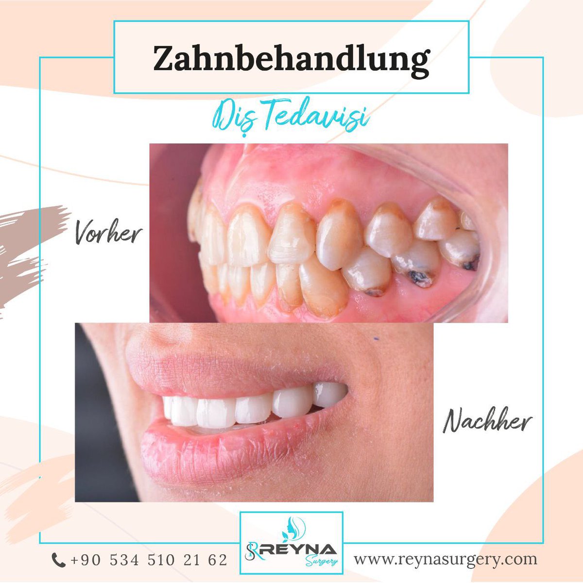 reyna_surgery's tweet photo. Zahnbehandlung-Diş Tedavisi🥰

📞 +90 534 510 2162

#dental #dentist #teeth #zahnmedizin #krone #implant #implants #bleaching #zahnreinigung #whiteteeth
#zahnarzt #pflege #clean #reynasurgery #deprem https://t.co/XQkYu2GgsD