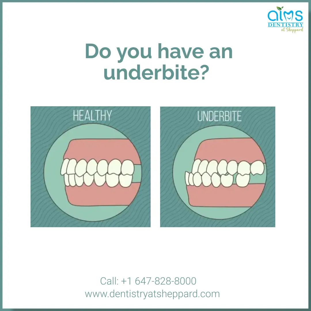aims_sheppard's tweet photo. A dental underbite occurs when the lower jaw is tilted too far forward, and the upper jaw is inclined too far to the rear.

Would you be interested in learning more about the benefits of underbite correction?

If so, set up an appointment today.

#AIMS #aimsdentistrysheppard https://t.co/xy5KQcDgje